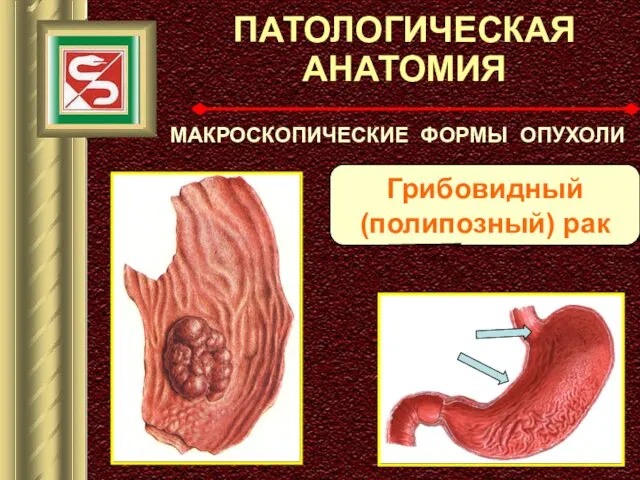 ПАТОЛОГИЧЕСКАЯ АНАТОМИЯ МАКРОСКОПИЧЕСКИЕ ФОРМЫ ОПУХОЛИ Грибовидный (полипозный) рак