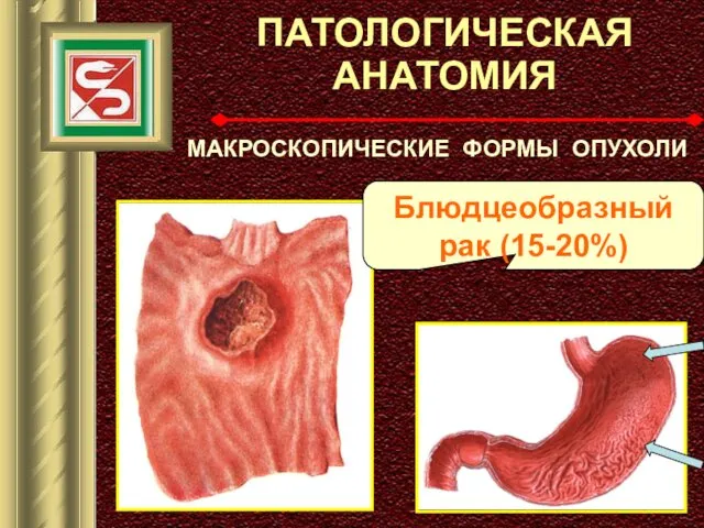 ПАТОЛОГИЧЕСКАЯ АНАТОМИЯ МАКРОСКОПИЧЕСКИЕ ФОРМЫ ОПУХОЛИ Блюдцеобразный рак (15-20%)