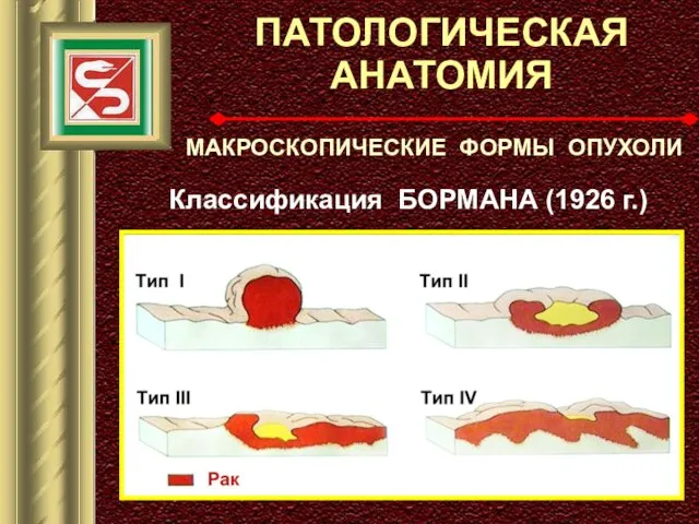 ПАТОЛОГИЧЕСКАЯ АНАТОМИЯ МАКРОСКОПИЧЕСКИЕ ФОРМЫ ОПУХОЛИ Классификация БОРМАНА (1926 г.)