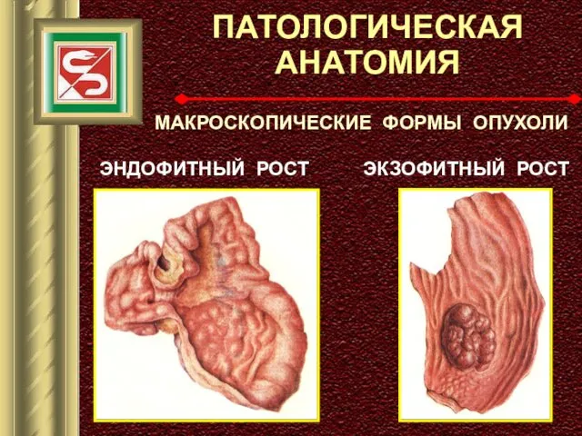 ПАТОЛОГИЧЕСКАЯ АНАТОМИЯ МАКРОСКОПИЧЕСКИЕ ФОРМЫ ОПУХОЛИ ЭНДОФИТНЫЙ РОСТ ЭКЗОФИТНЫЙ РОСТ