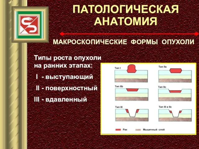 ПАТОЛОГИЧЕСКАЯ АНАТОМИЯ МАКРОСКОПИЧЕСКИЕ ФОРМЫ ОПУХОЛИ Типы роста опухоли на ранних этапах: