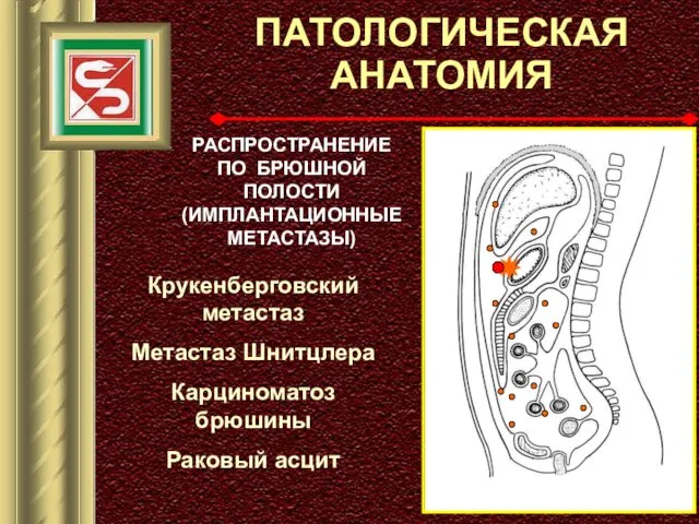 ПАТОЛОГИЧЕСКАЯ АНАТОМИЯ РАСПРОСТРАНЕНИЕ ПО БРЮШНОЙ ПОЛОСТИ (ИМПЛАНТАЦИОННЫЕ МЕТАСТАЗЫ) Крукенберговский метастаз Метастаз Шнитцлера Карциноматоз брюшины Раковый асцит