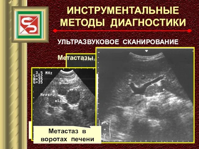 ИНСТРУМЕНТАЛЬНЫЕ МЕТОДЫ ДИАГНОСТИКИ УЛЬТРАЗВУКОВОЕ СКАНИРОВАНИЕ ПЕРВИЧНАЯ ОПУХОЛЬ (эндофитный рост) Метастазы в