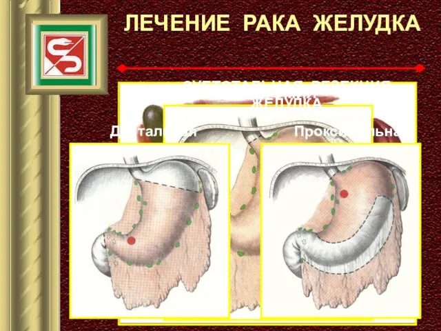 ЛЕЧЕНИЕ РАКА ЖЕЛУДКА ГАСТРЭКТОМИЯ СУБТОТАЛЬНАЯ РЕЗЕКЦИЯ ЖЕЛУДКА Дистальная Проксимальная