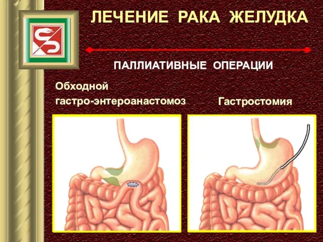 ЛЕЧЕНИЕ РАКА ЖЕЛУДКА ПАЛЛИАТИВНЫЕ ОПЕРАЦИИ Обходной гастро-энтероанастомоз Гастростомия