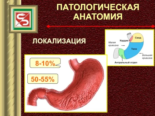 ПАТОЛОГИЧЕСКАЯ АНАТОМИЯ ЛОКАЛИЗАЦИЯ 50-55% 8-10%