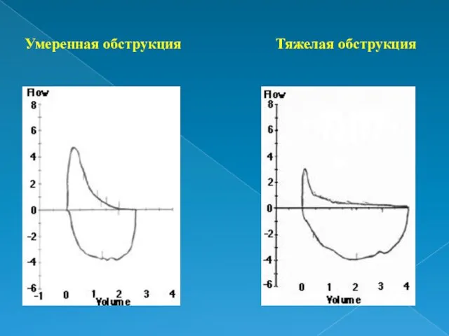 Умеренная обструкция Тяжелая обструкция