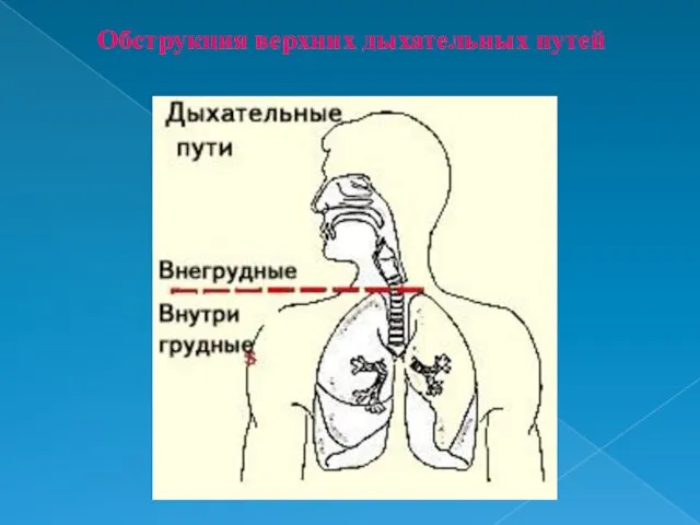 Обструкция верхних дыхательных путей