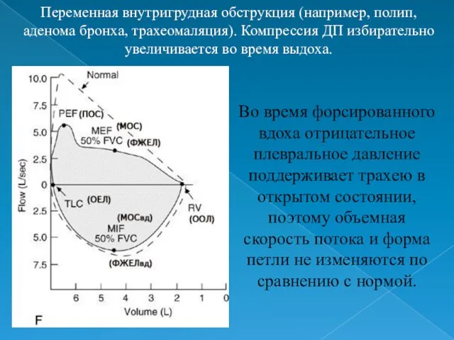 Переменная внутригрудная обструкция (например, полип, аденома бронха, трахеомаляция). Компрессия ДП избирательно