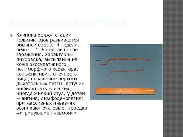 КЛИНИЧЕСКАЯ КАРТИНА Клиника острой стадии гельминтозов развивается обычно через 2—4 недели,