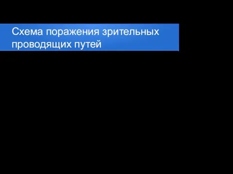 Схема поражения зрительных проводящих путей