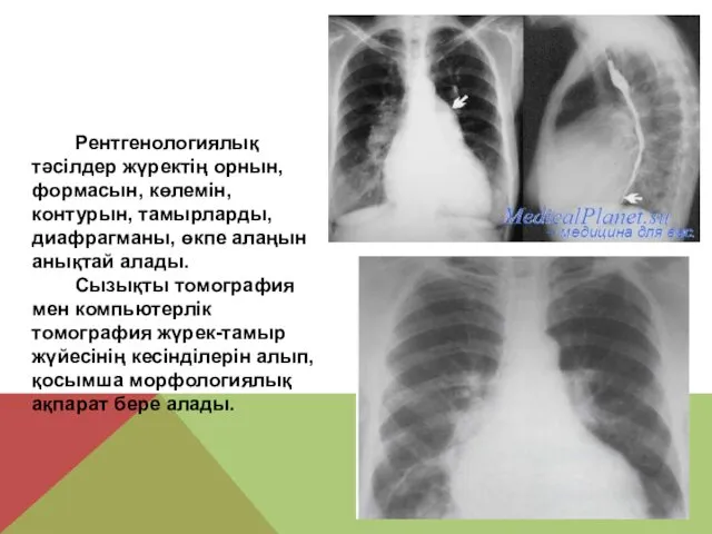 Рентгенологиялық тәсілдер жүректің орнын, формасын, көлемін, контурын, тамырларды, диафрагманы, өкпе алаңын