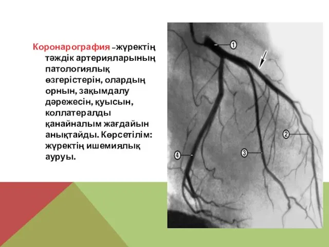 Коронарография –жүректің тәждік артерияларының патологиялық өзгерістерін, олардың орнын, зақымдалу дәрежесін, қуысын,