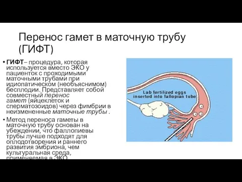 Перенос гамет в маточную трубу (ГИФТ) ГИФТ– процедура, которая используется вместо