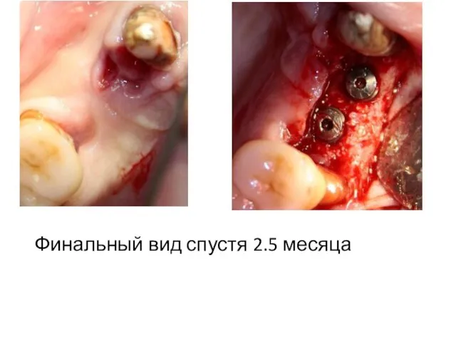 Финальный вид спустя 2.5 месяца