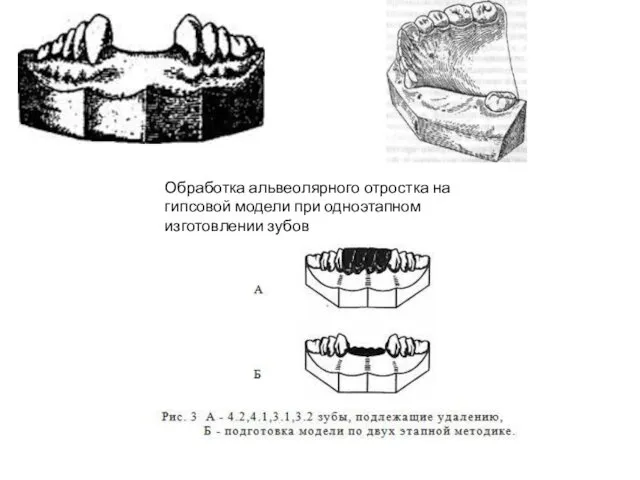 Обработка альвеолярного отростка на гипсовой модели при одноэтапном изготовлении зубов