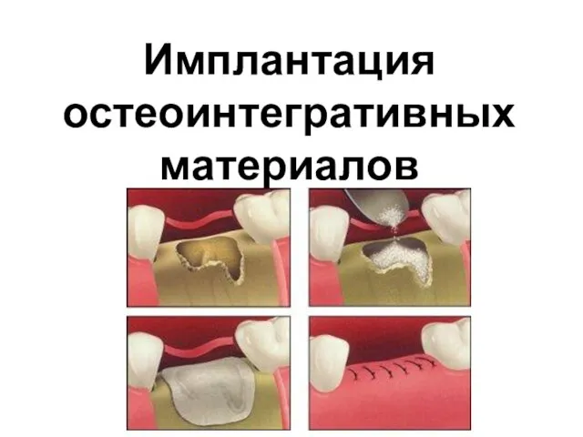 Имплантация остеоинтегративных материалов