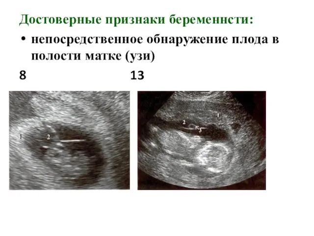 Достоверные признаки беременнсти: непосредственное обнаружение плода в полости матке (узи) 8 13