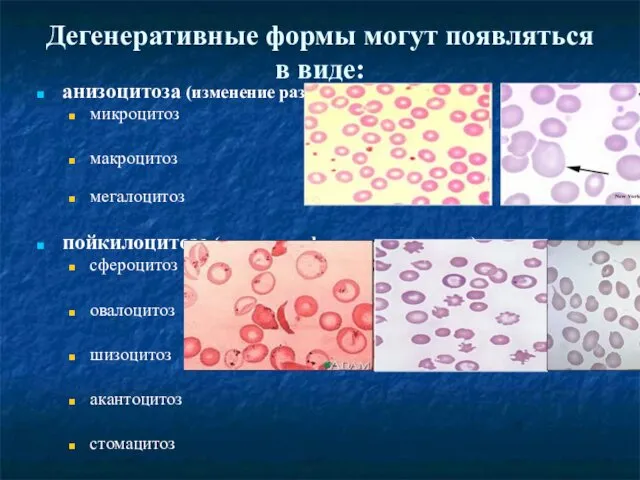 Дегенеративные формы могут появляться в виде: анизоцитоза (изменение размера) микроцитоз макроцитоз