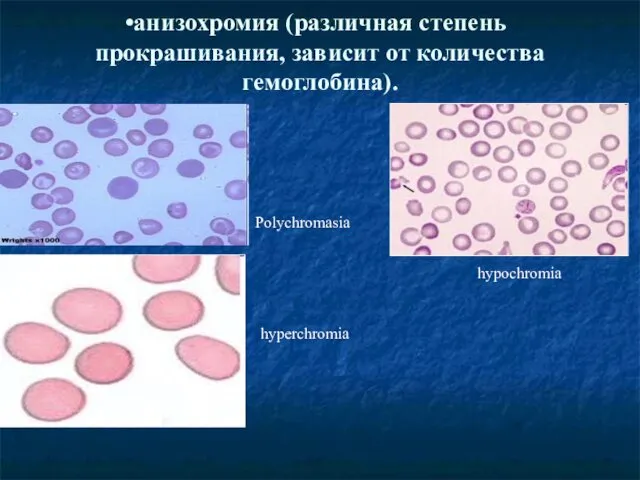 анизохромия (различная степень прокрашивания, зависит от количества гемоглобина). Polychromasia hyperchromia hypochromia