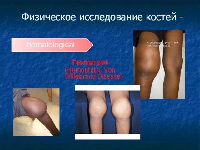 Физическое исследование костей - Гемартроз (Hemophilia, Von Willebrand Disease) hematological