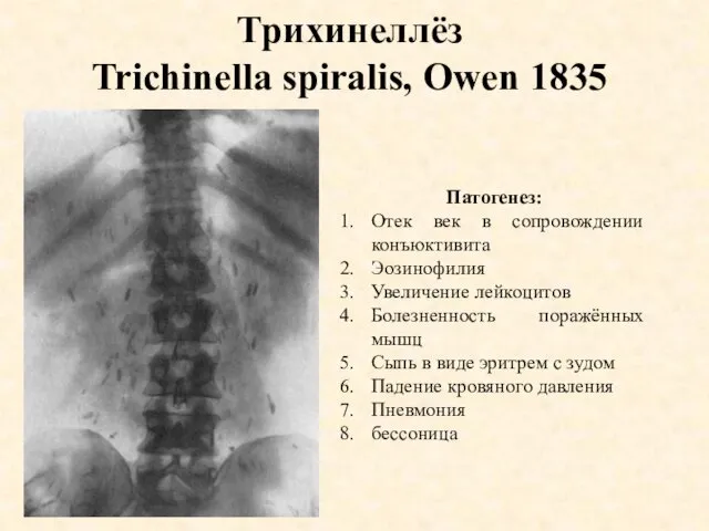 Трихинеллёз Trichinella spiralis, Owen 1835 Патогенез: Отек век в сопровождении конъюктивита