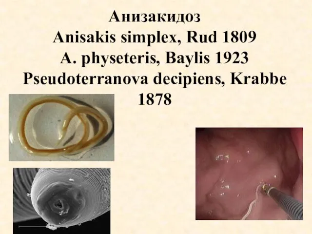 Анизакидоз Anisakis simplex, Rud 1809 A. physeteris, Baylis 1923 Pseudoterranova decipiens, Krabbe 1878