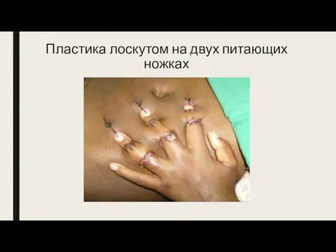 Пластика лоскутом на двух питающих ножках