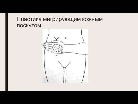 Пластика мигрирующим кожным лоскутом