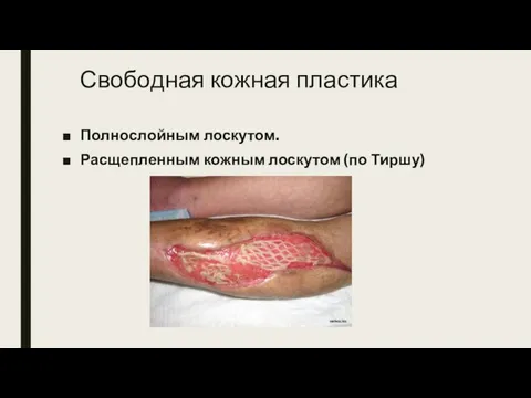 Свободная кожная пластика Полнослойным лоскутом. Расщепленным кожным лоскутом (по Тиршу)