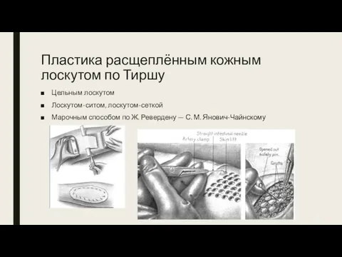 Пластика расщеплённым кожным лоскутом по Тиршу Цельным лоскутом Лоскутом-ситом, лоскутом-сеткой Марочным