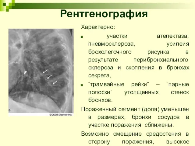 Характерно: участки ателектаза, пневмосклероза, усилеия брохолегочного рисунка в результате перибронхиального склероза