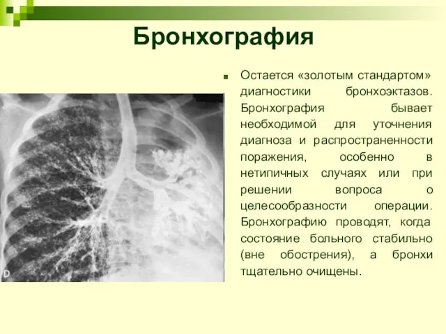 Бронхография Остается «золотым стандартом» диагностики бронхоэктазов. Бронхография бывает необходимой для уточнения