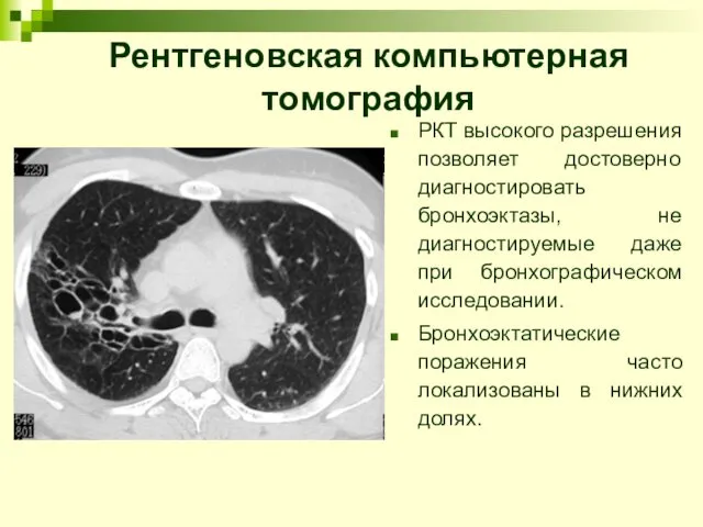 Рентгеновская компьютерная томография РКТ высокого разрешения позволяет достоверно диагностировать бронхоэктазы, не