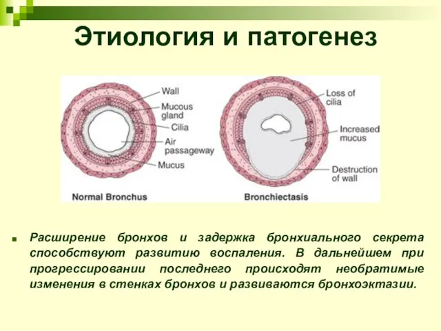 Этиология и патогенез Расширение бронхов и задержка бронхиального секрета способствуют развитию