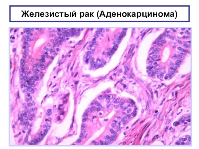 Железистый рак (Аденокарцинома)