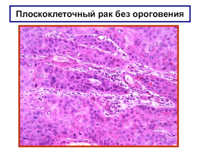 Плоскоклеточный рак без ороговения