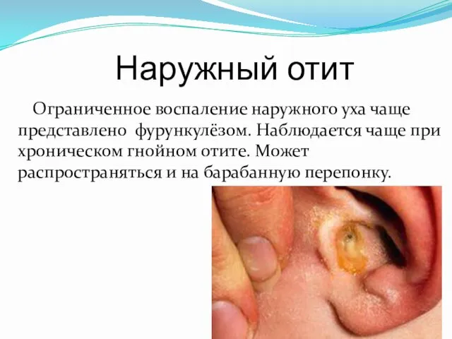 Наружный отит Ограниченное воспаление наружного уха чаще представлено фурункулёзом. Наблюдается чаще