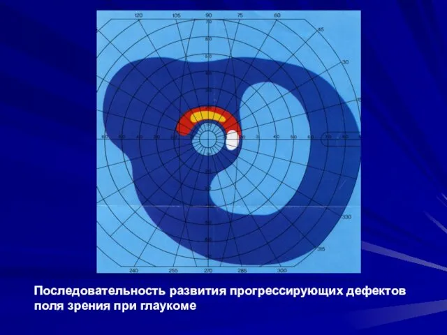 Последовательность развития прогрессирующих дефектов поля зрения при глаукоме