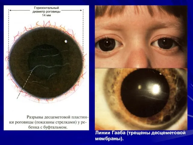 Линии Гааба (трещены десцеметовой мембраны).