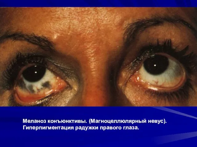 Меланоз конъюнктивы. (Магноцеллюлярный невус). Гиперпигментация радужки правого глаза.