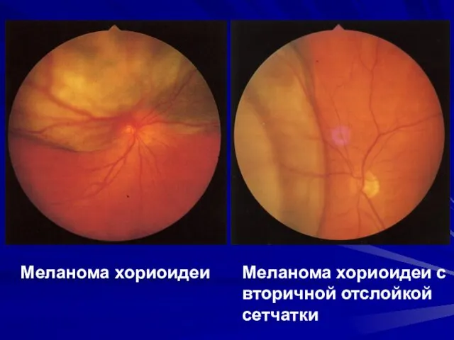 Меланома хориоидеи Меланома хориоидеи с вторичной отслойкой сетчатки
