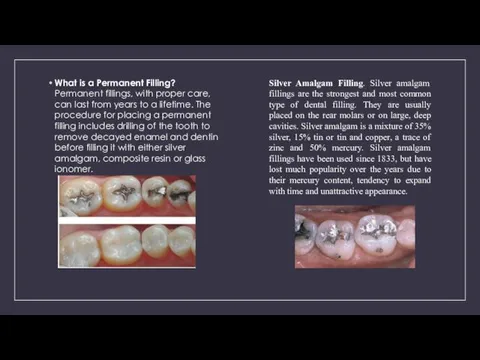 What is a Permanent Filling? Permanent fillings, with proper care, can