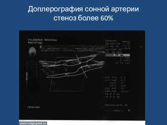 Доплерография сонной артерии стеноз более 60%
