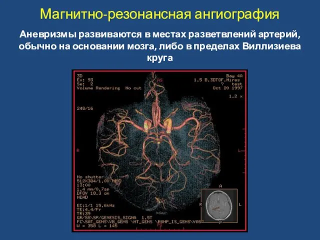 Магнитно-резонансная ангиография Аневризмы развиваются в местах разветвлений артерий, обычно на основании