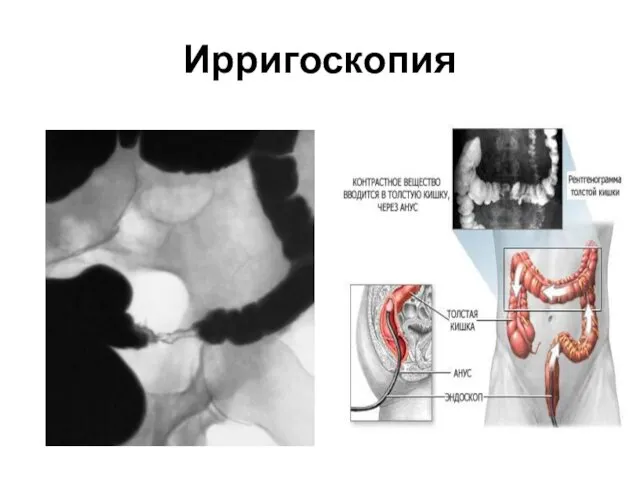 Ирригоскопия