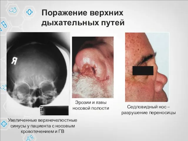 Поражение верхних дыхательных путей Эрозии и язвы носовой полости Седловидный нос