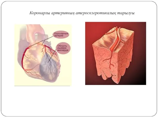 Коронарлы артерияның атеросклеротикалық тарылуы