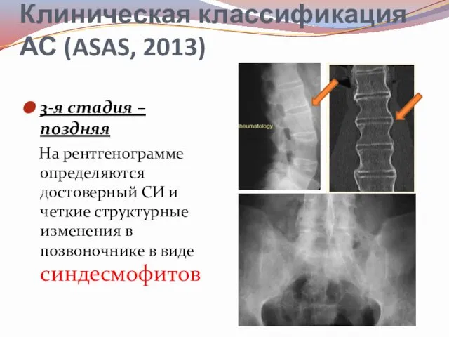 Клиническая классификация АС (ASAS, 2013) 3-я стадия – поздняя На рентгенограмме