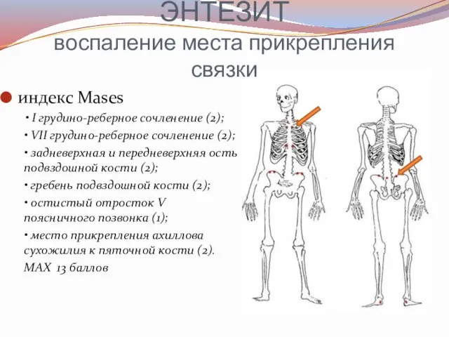 ЭНТЕЗИТ воспаление места прикрепления связки индекс Mases • I грудино-реберное сочленение